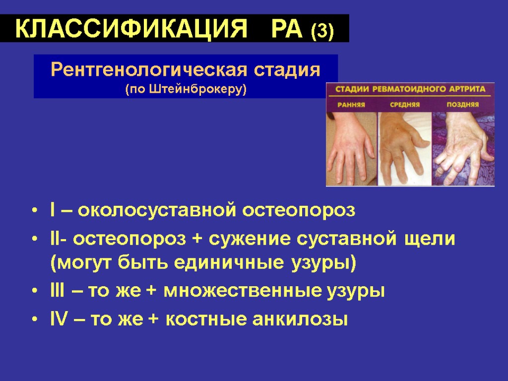 КЛАССИФИКАЦИЯ РА (3) I – околосуставной остеопороз II- остеопороз + сужение суставной щели (могут